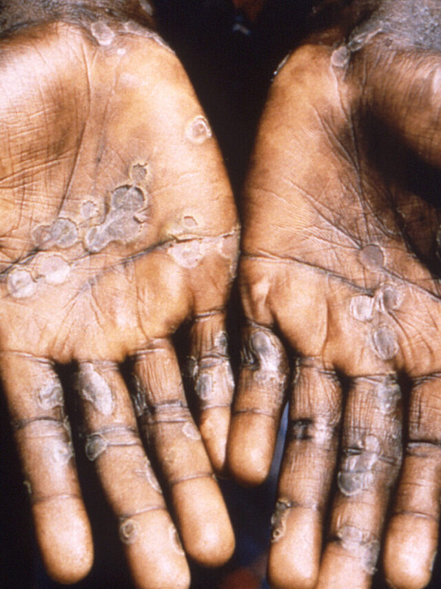 What Is Monkeypox? Signs, Symtoms and Treatment