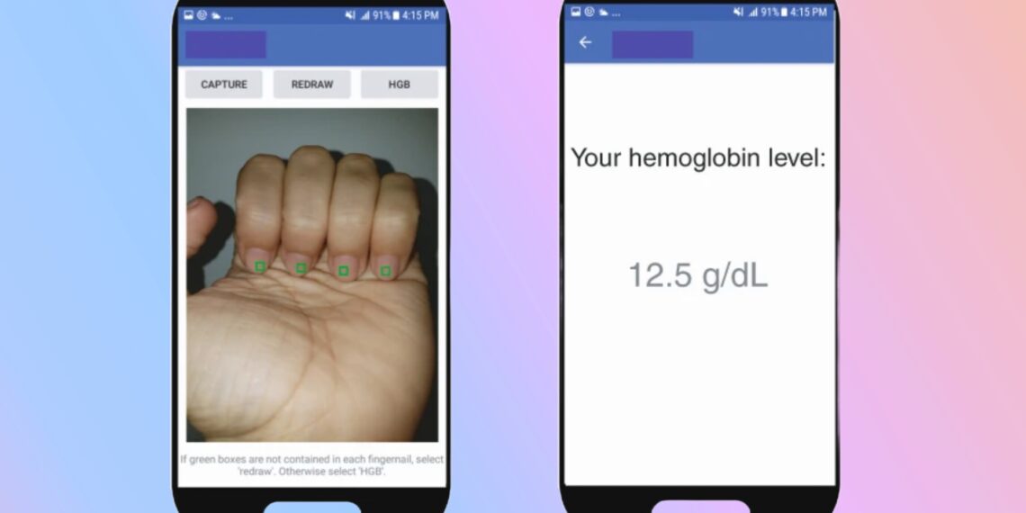 AI App Takes Nail Selfie to Spot Blood Condition Affecting Billions
