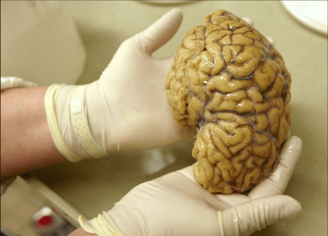 A laboratory assistant holds one hemisphere of a healthy brain in the Morphological unit of psychopathology at Belle Idee University Hospital near Geneva, March 14, 2011. Source: REUTERS