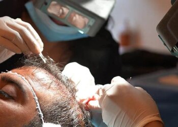 Dubai Police Bust Illegal Hair Transplant Clinic Thief