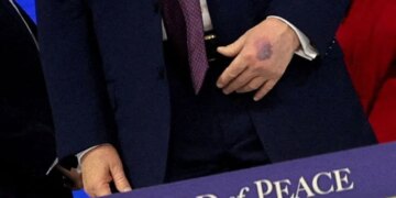 New photos reveal bruised hands of Trump