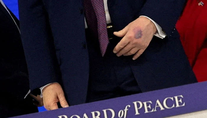 New photos reveal bruised hands of Trump