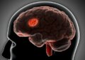 Stroke Might Reverse Brain Aging, Study Reveals
