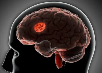 Stroke Might Reverse Brain Aging, Study Reveals