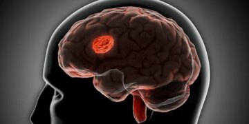 Stroke Might Reverse Brain Aging, Study Reveals