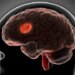 Stroke Might Reverse Brain Aging, Study Reveals