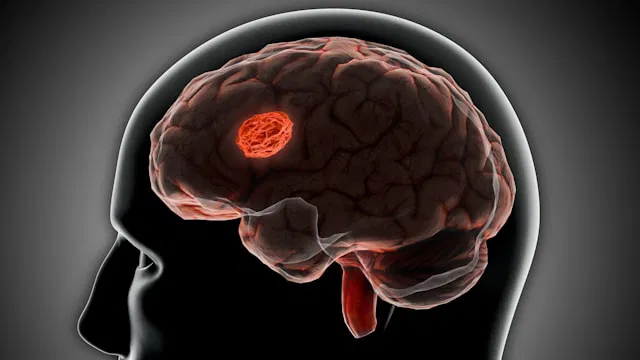 Stroke Might Reverse Brain Aging, Study Reveals