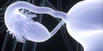 Innovative Tool Could Help Detect Ovarian Cancer Early