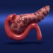 New Drug Offers Hope for Longer Pancreatic Cancer Survival