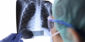 Researchers Discover New Method to Slow Breast Cancer Spread to Lungs