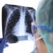 Researchers Discover New Method to Slow Breast Cancer Spread to Lungs